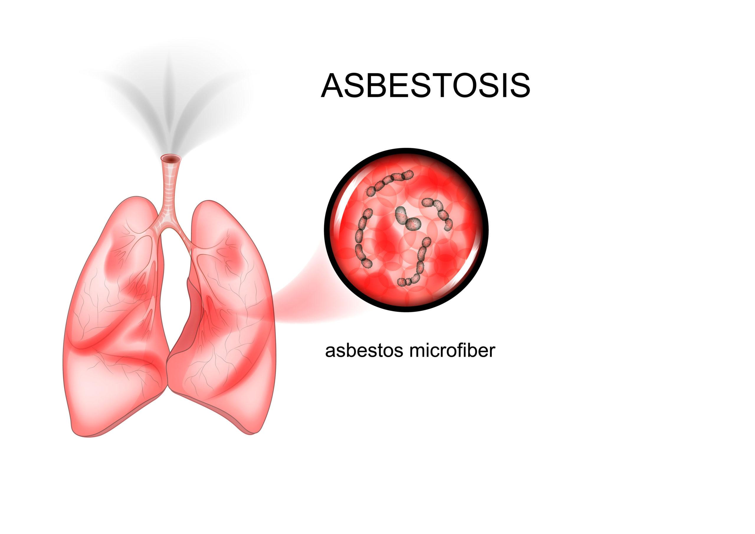 asbestosis disease